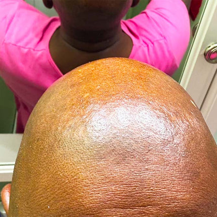 WestandHome’s Ingrown Hair Treatment 2.0